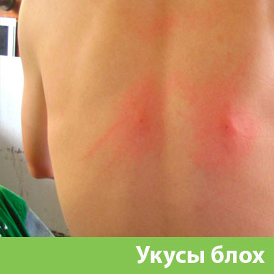 Укусы блох в Каменске-Уральском