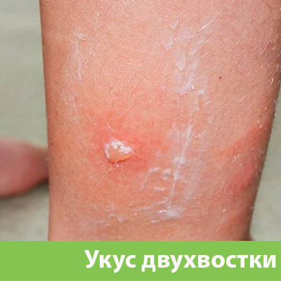 Укус двухвостки в Каменске-Уральском