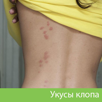 Профессиональное уничтожение клопов в Каменске-Уральском